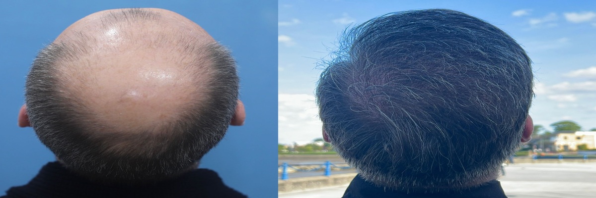 The Face Center - Hair Transplant Surgery | Hair