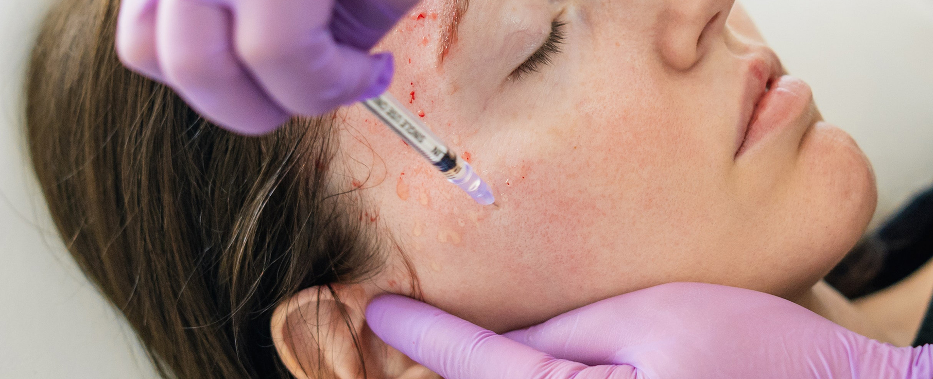The Face Center - Vampire Facial Treatment | Aesthetic Treatments